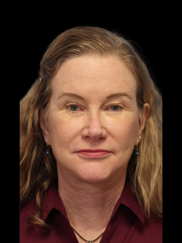 Blepharoplasty Before & After