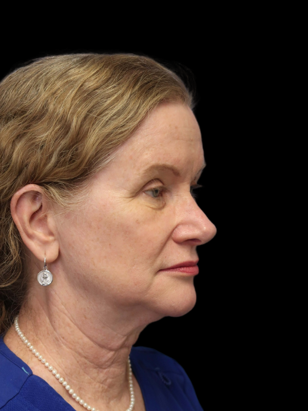 Blepharoplasty Before & After