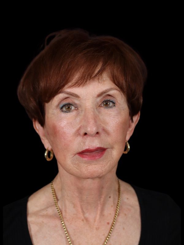 Blepharoplasty Before & After