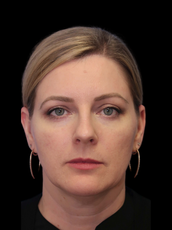 Blepharoplasty Before & After