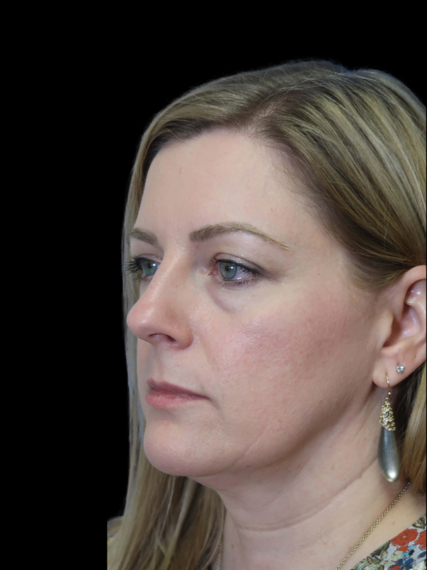 Blepharoplasty Before & After
