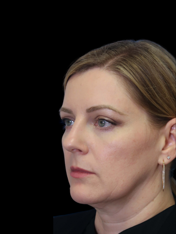 Blepharoplasty Before & After