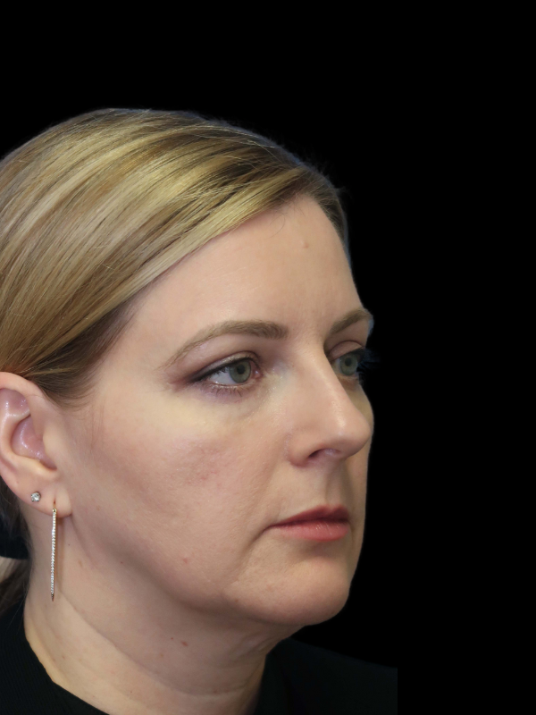 Blepharoplasty Before & After