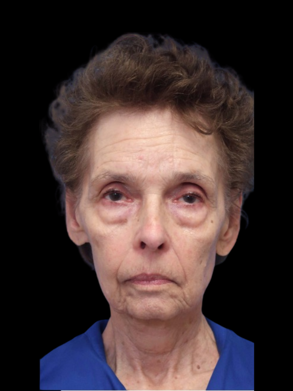 Blepharoplasty Before & After