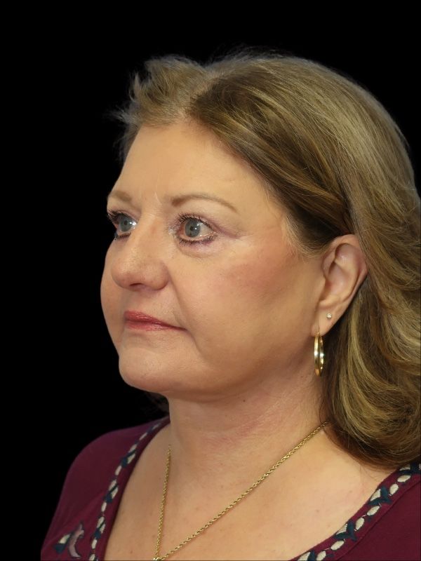 Blepharoplasty Before & After