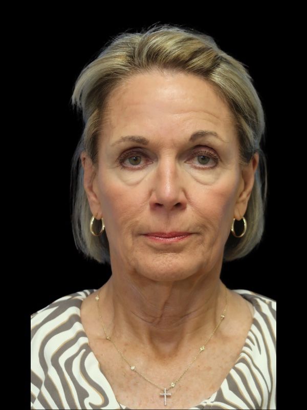 Blepharoplasty Before & After