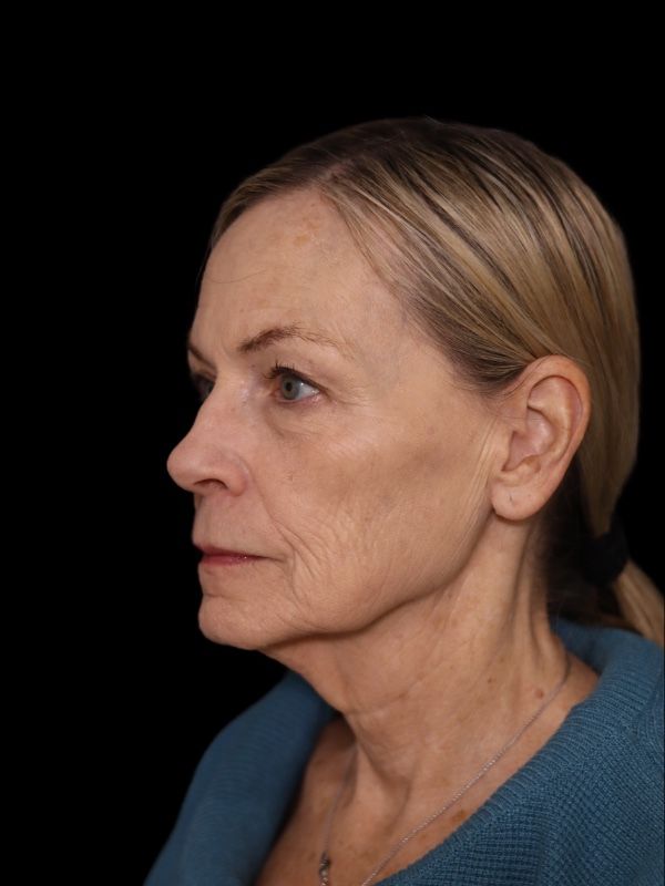Blepharoplasty Before & After