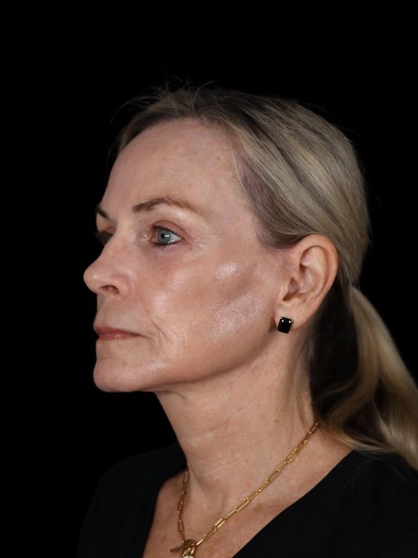 Blepharoplasty Before & After