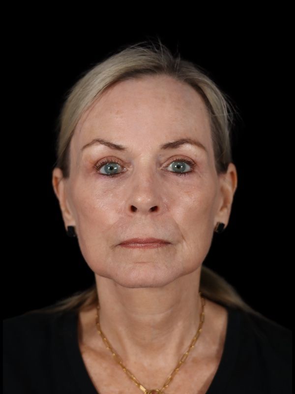 Blepharoplasty Before & After