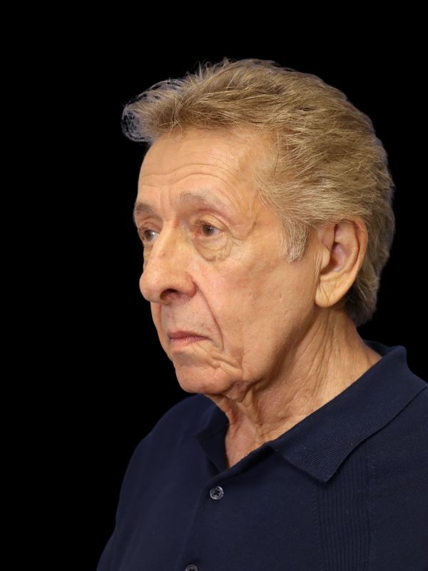 Blepharoplasty Before & After