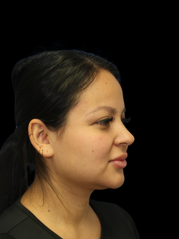 Facetite Before & After