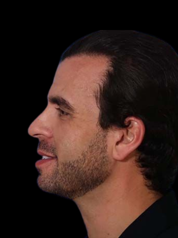 Facetite Before & After