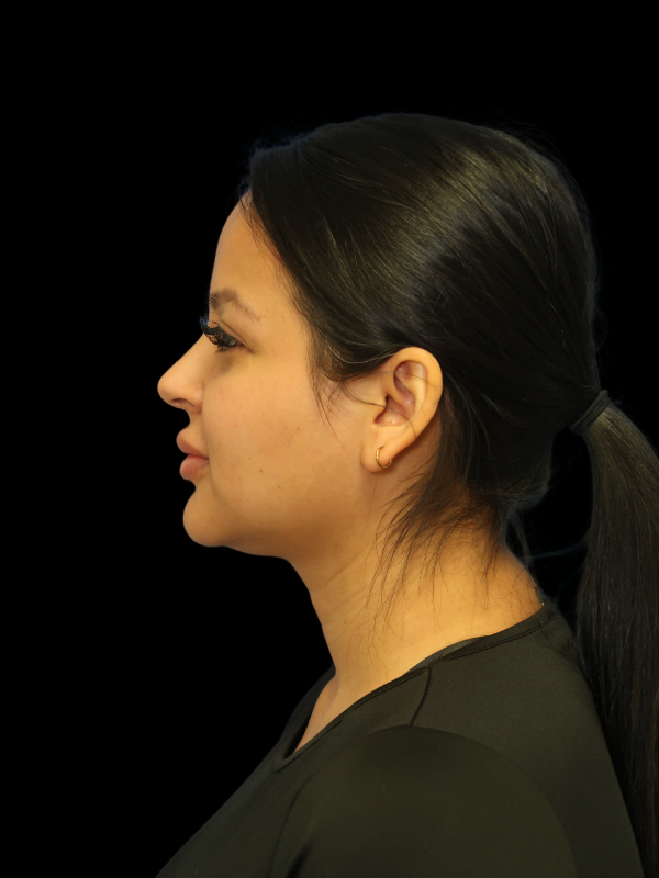 Facetite Before & After