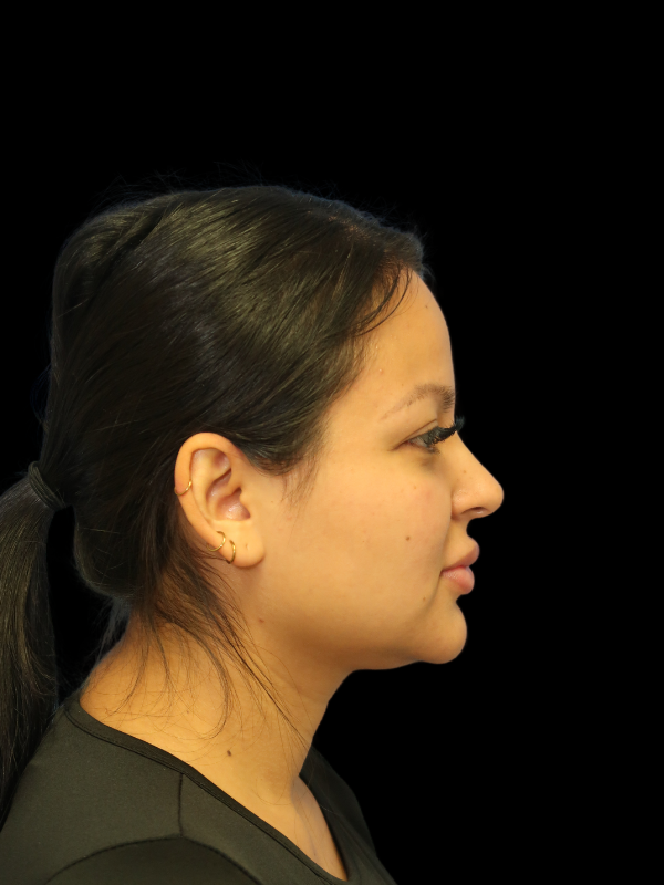 Facetite Before & After