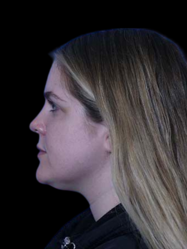 Facetite Before & After