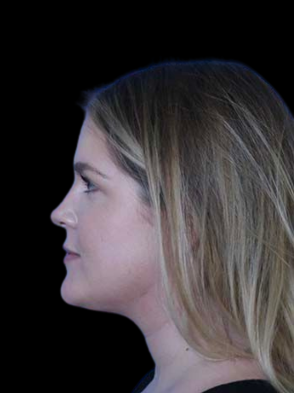 Facetite Before & After