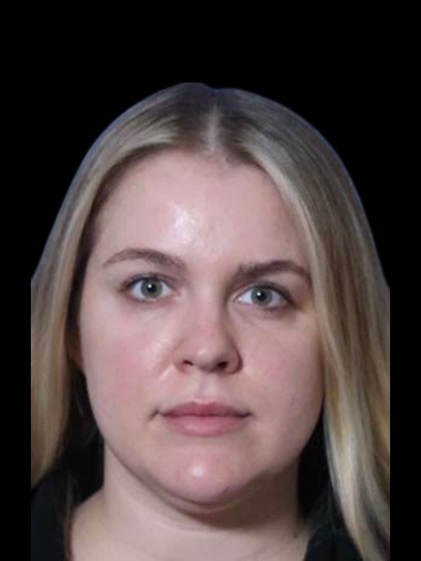 Facetite Before & After