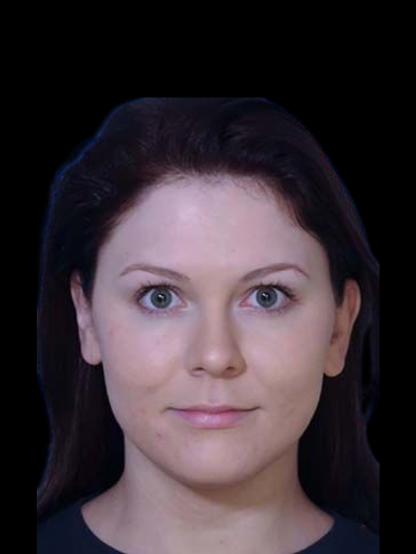 Facetite Before & After