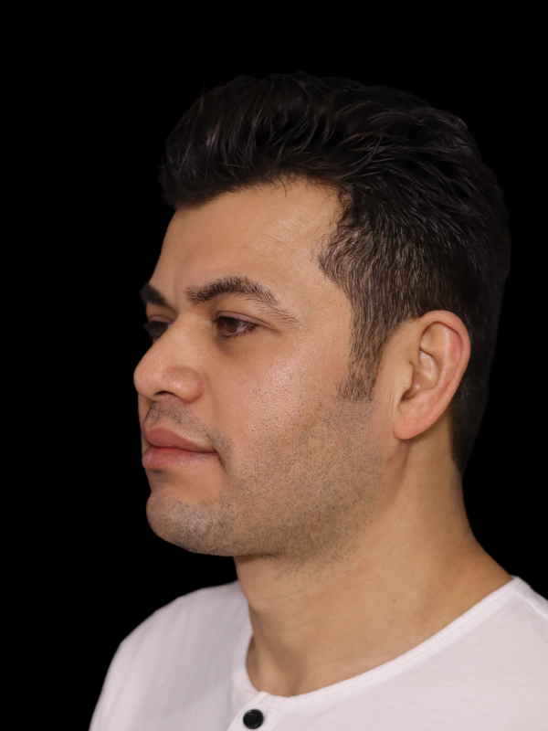 Facetite Before & After