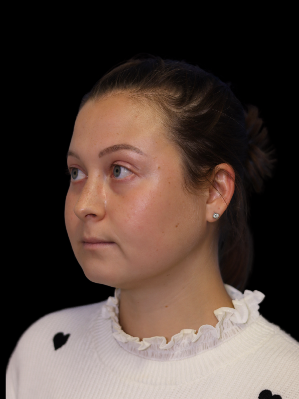 Facetite Before & After