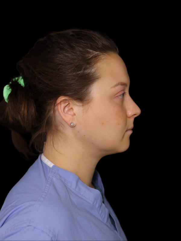 Facetite Before & After