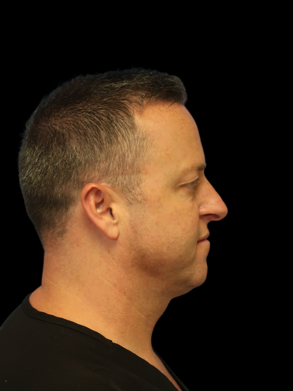 Facetite Before & After