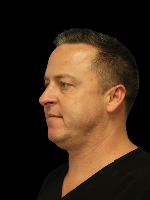 Facetite Before & After