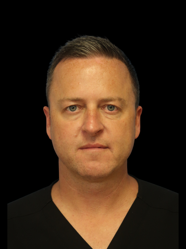 Facetite Before & After