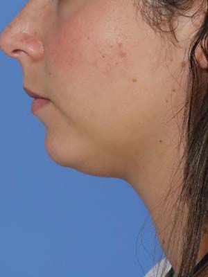 Acne Scarring Before & After