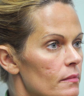 Acne Scarring Before & After