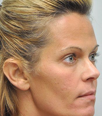 Acne Scarring Before & After