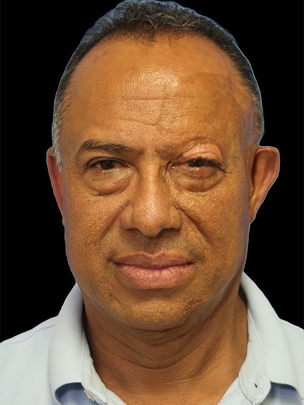 Hair Loss Restoration Before & After