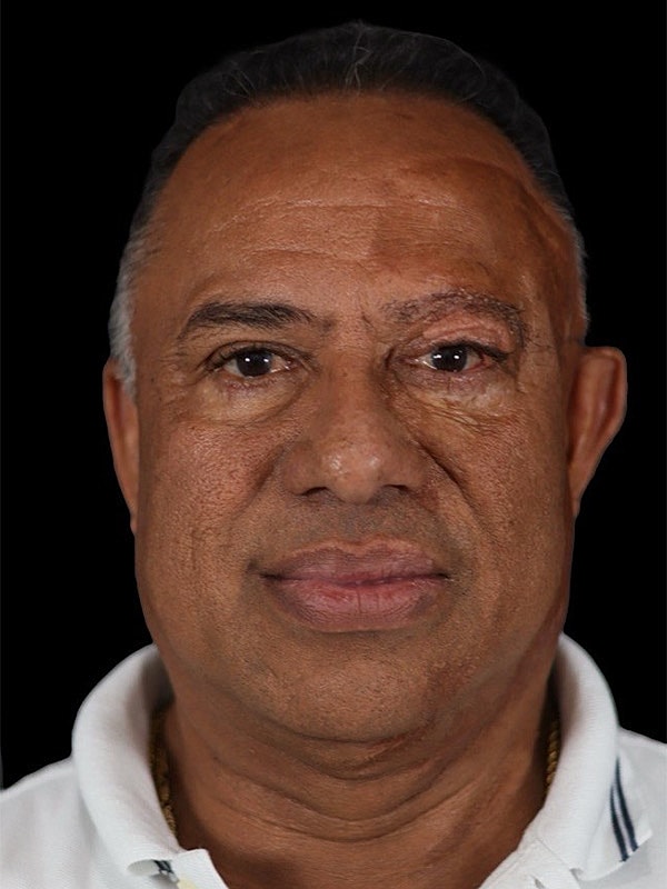 Hair Loss Restoration Before & After