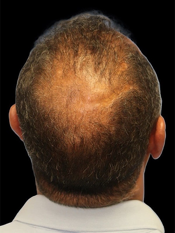 Hair Loss Restoration Before & After