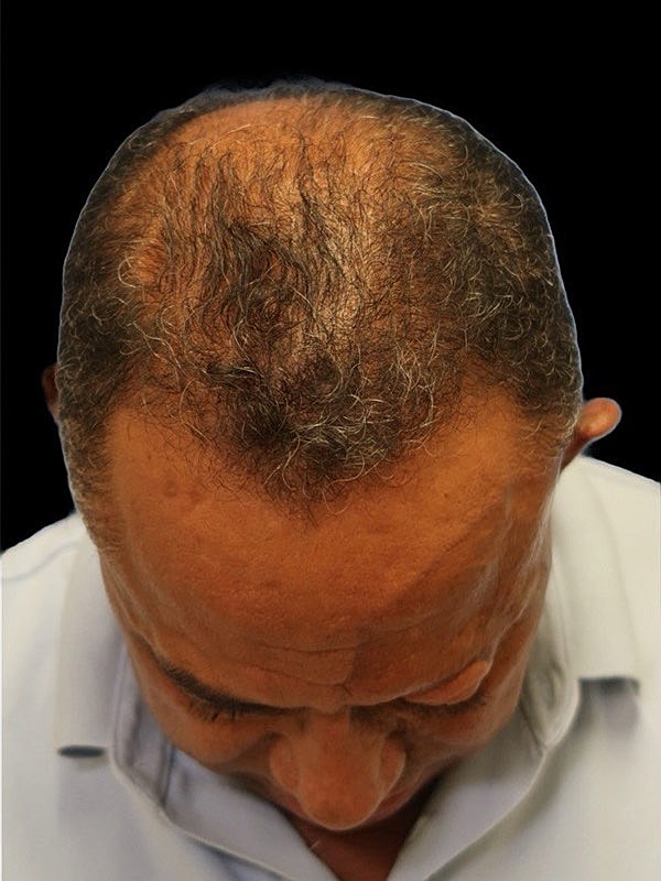 Hair Loss Restoration Before & After