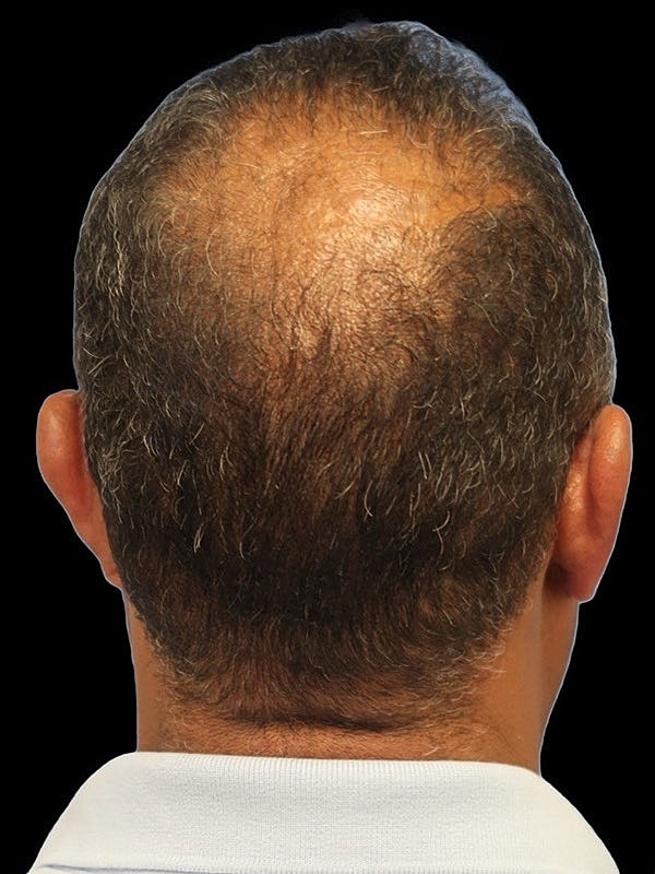 Hair Loss Restoration Before & After