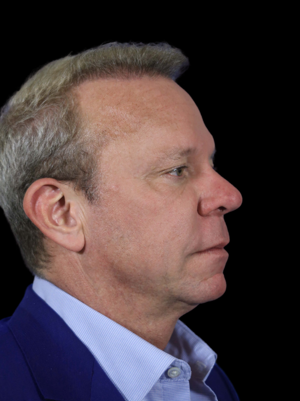 Hair Loss Restoration Before & After