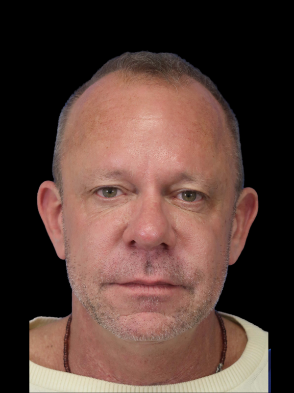 Hair Loss Restoration Before & After