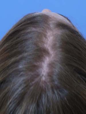 Hair Loss Restoration Before & After