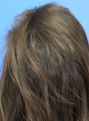 Hair Loss Restoration Before & After