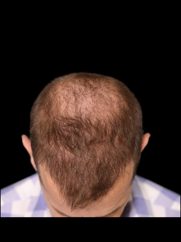Hair Loss Restoration Before & After