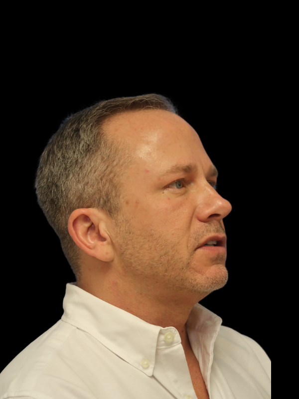 Hair Loss Restoration Before & After