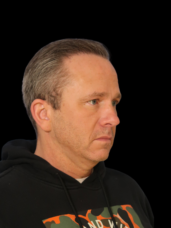 Hair Loss Restoration Before & After