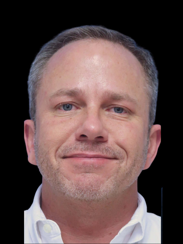 Hair Loss Restoration Before & After