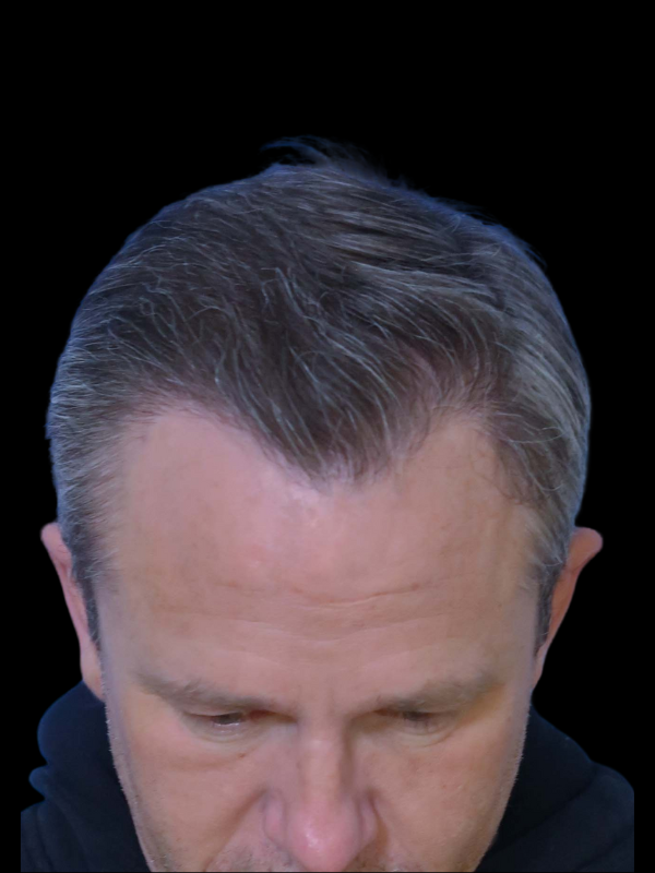 Hair Loss Restoration Before & After