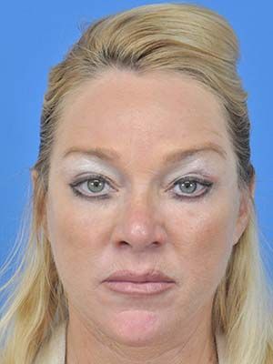 Facial Fat Grafting Before & After