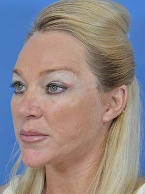 Facial Fat Grafting Before & After