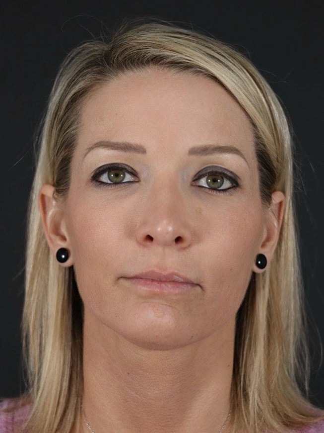 Facial Fat Grafting Before & After