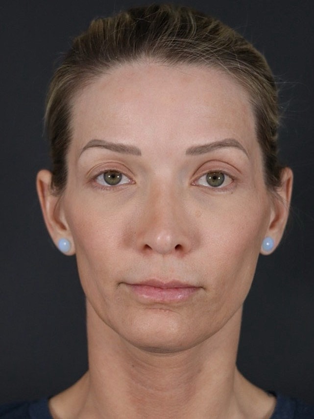 Facial Fat Grafting Before & After