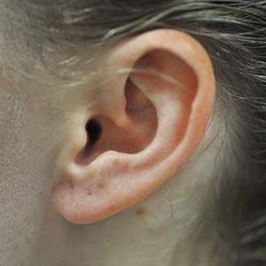 Earlobe Repair Before & After